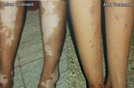 Skin grafting for vitiligo